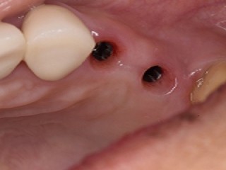 Dental crowns in Tijuana