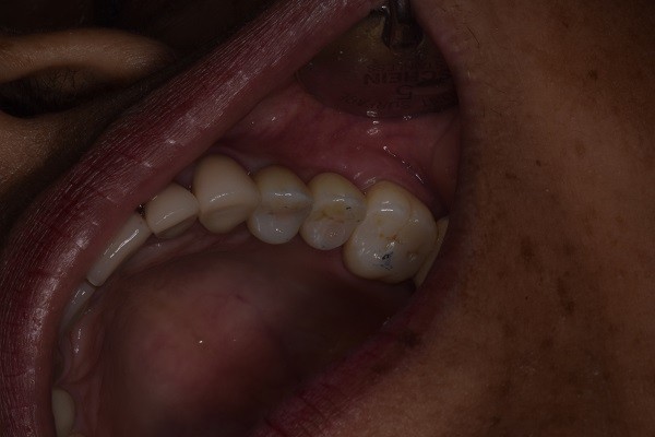 transform-your-smile-and-appeal-with-steadfast-cosmetic-dentist-in-tijuana-big-0