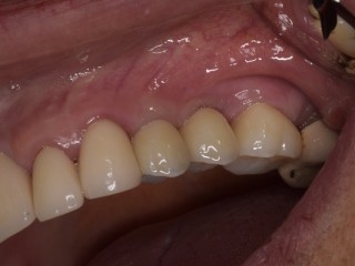 Find top-notch surgeons and dental equipment for Wisdom teeth removal Tijuana