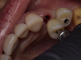 Holistic Dentist in Mexico Natural, Biocompatible Care for Your Health and Smile