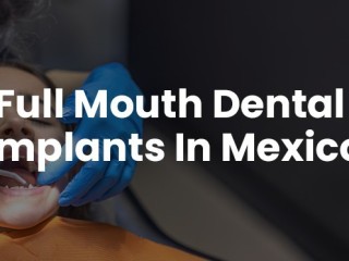 Full Mouth Dental Implants in Mexico with Teeth Savers