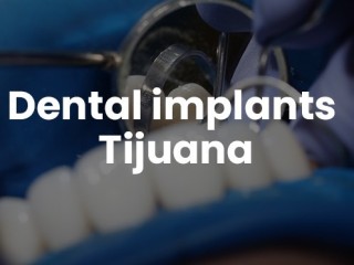 Dental implants Tijuana offers natural-looking and durable teeth replacements